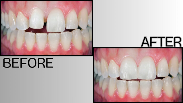 Las carillas dentales constituyen uno de los tratamientos estéticos más precisos y elegantes dentro de la odontología moderna.