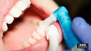 Curetajes dentales, la clave para unas encías sanas