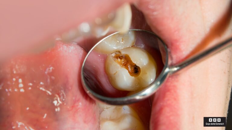 Las caries dentales son una de las enfermedades bucodentales más comunes en niños y adultos. Detectarlas a tiempo es clave para evitar complicaciones mayores y tratamientos más complejos