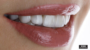 Las carillas dentales representan uno de los tratamientos más versátiles y transformadores dentro de la odontología estética actual, combinando precisión clínica con un resultado visual natural y elegante.