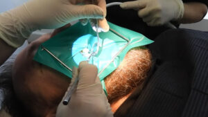 Tratamiento de endodoncia en clínica dental para eliminar infección y salvar el diente natural