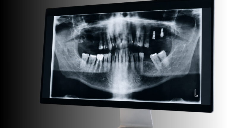 Radiografía panorámica dental mostrada en una pantalla de ordenador durante la planificación de un tratamiento de implantología en Grupo Dental Domenech.