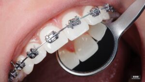 ratamiento de ortodoncia con brackets metálicos en Grupo Dental Domenech.